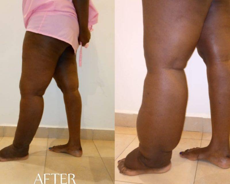 Patient outcome from lymphedema management programme